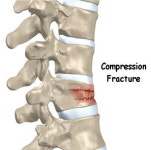 [김태겸의 척추이야기] 겨울철에는 척추압박골절 조심