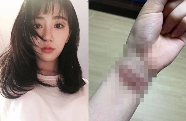 권민아, 손목 자해 사진 공개 