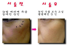 얼굴 축소와 주름 제거, 침으로 OK