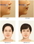 “안면윤곽수술, 연령대가 높아지고 있다”