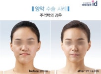치과? 성형외과? 양악수술, 전문병원 여부가 더 중요