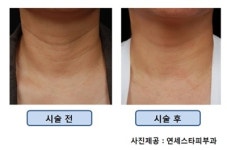 목의 나이테, 지울 수 있을까?