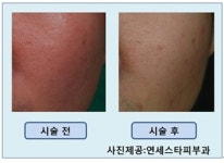 추운 겨울‘안면홍조’, 그냥 두지 마세요