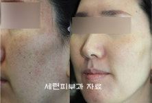 기미와 주근깨, 검버섯까지 색소질환 치료에 좋은 계절