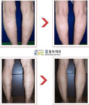 하지정맥류, 증상에 따라 치료법도 다르다.