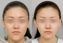 ‘미니V라인 앞턱수술’, 자연스럽고 매끈한 V라인 자신감
