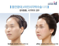 어떠한 헤어스타일도 OK, 작고 갸름한 얼굴 만드는 ‘동안광대수술’
