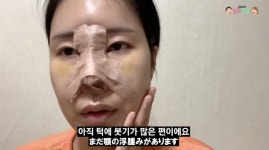 이세영 코 성형 지옥, 생각보다 빡세…코뼈 절골 심각한 붓기[종합]