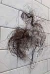25세 셀럽, 살빼는 주사(마운자로) 후 충격적 탈모 공개..