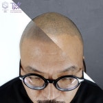 탈모왕 마이크로, ‘SMP두피문신 제대로 알고 시술받아야’