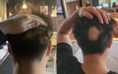 화이자 맞고 주먹 크기 원형탈모 생겨…예비신랑이의 백신 부작용 호소