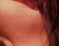 오톨도톨 모공각화증, 치료보다 중요한 ‘보습 유지’