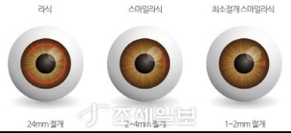  온누리스마일안과, 극최소절개 스마일라식 기술·기구 특허…1만안 치료