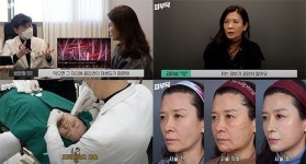프로파운드, 울쎄라·써마지보다 리프팅 효과 우수
