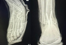 달리기도 못 한다...유명 의사, 왼발 아픈데 멀쩡한 오른발 절단수술