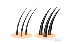 탈모 치료 ‘청신호’…국내 연구진, 모발 생성 세포 대량 배양 성공