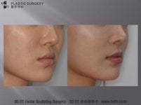[닥터 백의 3D FIT 이야기] 3D프린터 성형외과 영역에서의 활용 : 귀족수술 & 고양이 수술