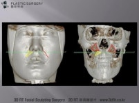 [닥터 백의 3D FIT 이야기] 3D프린터 성형외과 영역에서의 활용 : 귀족수술 & 고양이 수술