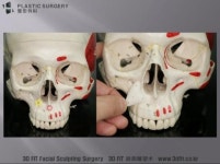 [닥터 백의 3D FIT 이야기] 3D프린터 성형외과 영역에서의 활용 : 귀족수술 & 고양이 수술