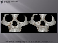 [닥터 백정환의 3D FIT 이야기] 3D프린터 성형외과 영역에서의 활용 : 앞광대 보형물