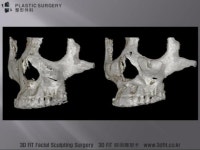 [닥터 백정환의 3D FIT 이야기] 3D프린터 성형외과 영역에서의 활용 : 앞광대 보형물