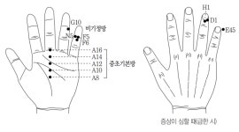 고려수지침학회가 전하는 배탈 증상 완화법