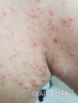 목포 요양병원 입원환자 ‘옴 질환 발생’ 충격