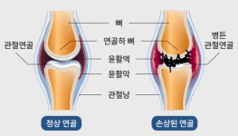 무릎 관절염 통증, 저강도 플리어스초음파로 잡는다