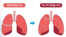 증상으로 구분 힘든 폐암, ‘이 검사’ 받아야 조기진단