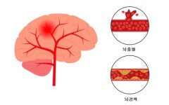 국내 사망원인 4위 뇌졸중… 치료 못 받고 병원 옮기기 일쑤