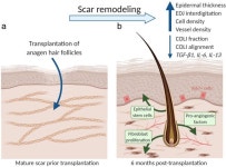 탈모에만 모낭이식?... 흉터 걱정도 해결 (연구)