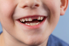 앞니 깨먹은 우리 아이... 유치니까 그냥 놔둬?