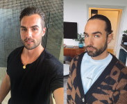 “이마가 V라서?...탈모 아닌데 모발이식한 모델男, 사연은?