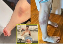 저절로 온몸에 멍 생겨... 21년간 의사도 모른 이 병, 女의 사연은?