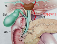 어렵다는 제4형 간문부 담도암 수술도 척척...