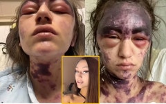 얼굴이 보라색 괴물처럼...백신 3개 맞고 10분만에 실명까지, 무슨 일?