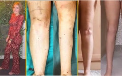 “사춘기 때 피임약 때문?”…다리만 뚱뚱했던 女, 전재산 털어 날씬 하체된 사연은?