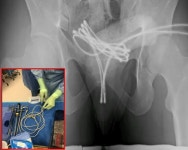 ”성적 쾌감 위해?” 요도에 USB 케이블 넣은 21세男... 세상에 무슨 일?