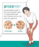 [W건강생활백서] 작은 충격에도 골절... 중년여성 골다공증 주의보