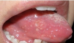 혓바늘 원인…증상 심하면 설암도 발병할 수 있어