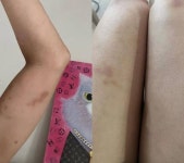 51세 미나, 온몸이 멍투성이+결국 병원신세…왜?