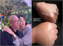 '신혼' 최여진김재욱, 퉁퉁 부은 손…