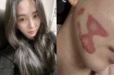 권민아, '얼굴 화상' 사고 딛고 피부과 취업…