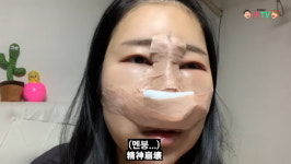 이세영, 대박 난 코성형…충격적인 붓기→완벽한 버선코 만족스럽다 [TEN★]