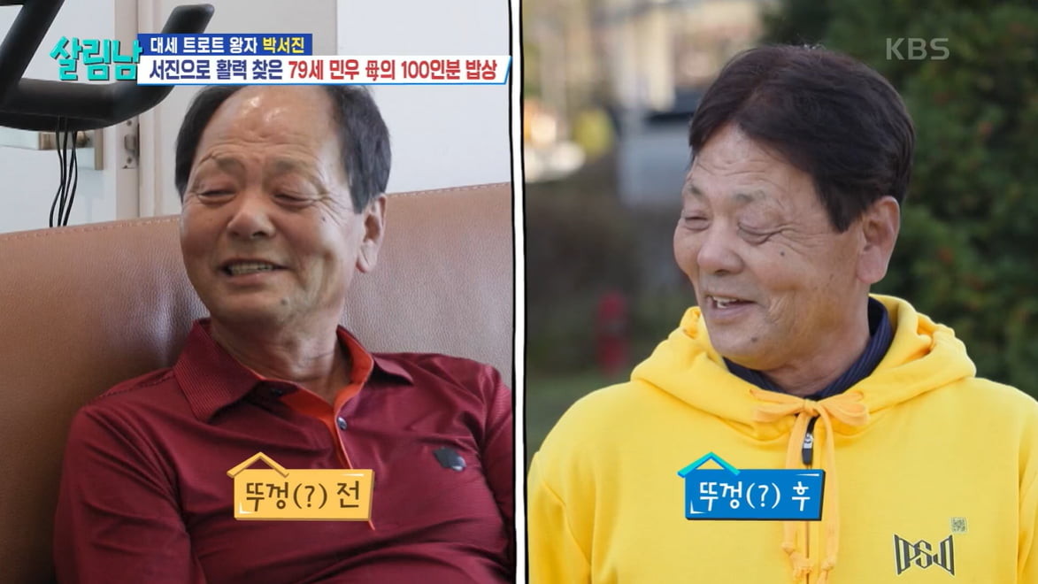 박서진, 럭셔리 스포츠카 한 대 가치의 성형·모발 이식 비용 공개