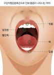 입안 화끈거리고, 혀가 아프다? 꾀병 아닌 구강작열감증후군