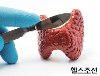 갑상선암, 정말 착하기만 할까?