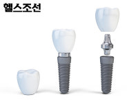 다양한 임플란트 재료, 어떤 걸 써야 할까?