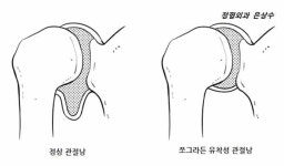[정형외과 운동법]오십견 진단과 운동법