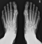 새끼발가락에 굳은살·통증… 신발 탓 마세요